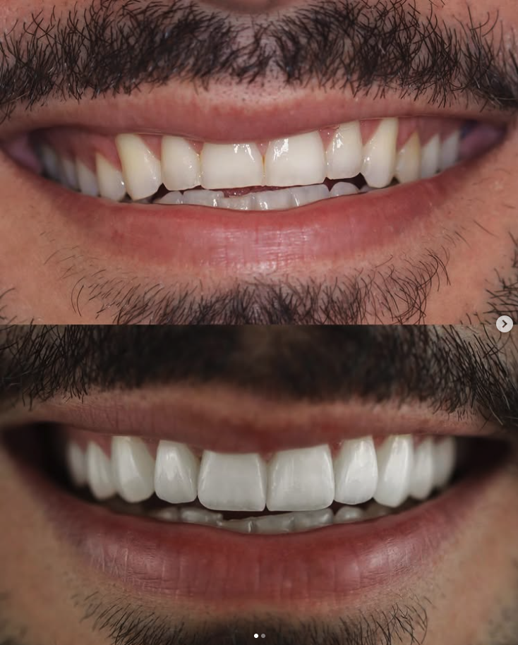 Resultado de Facetas de Resina Composta — Mesh Clinic