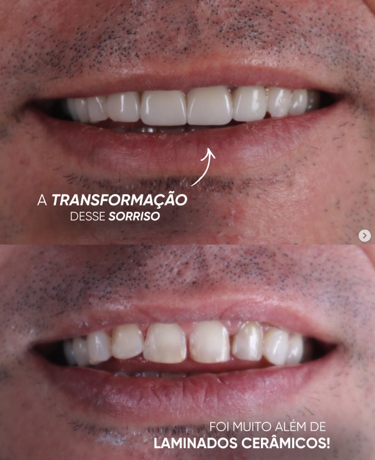 Resultado de Facetas de Porcelana — Mesh Clinic