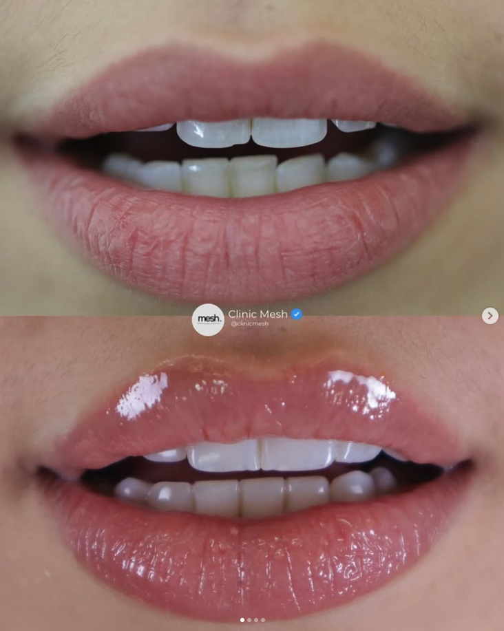 Resultado de Facetas de Resina Composta — Mesh Clinic