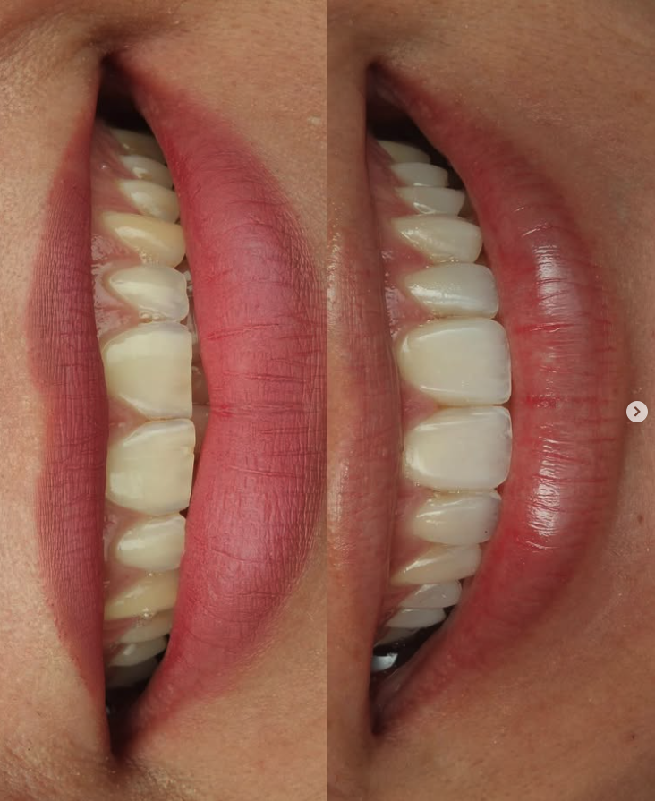 Resultado de Facetas de Resina Composta — Mesh Clinic
