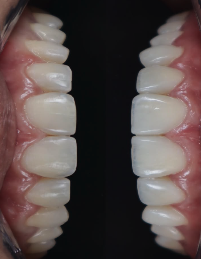 Resultado de Facetas de Resina Composta — Mesh Clinic