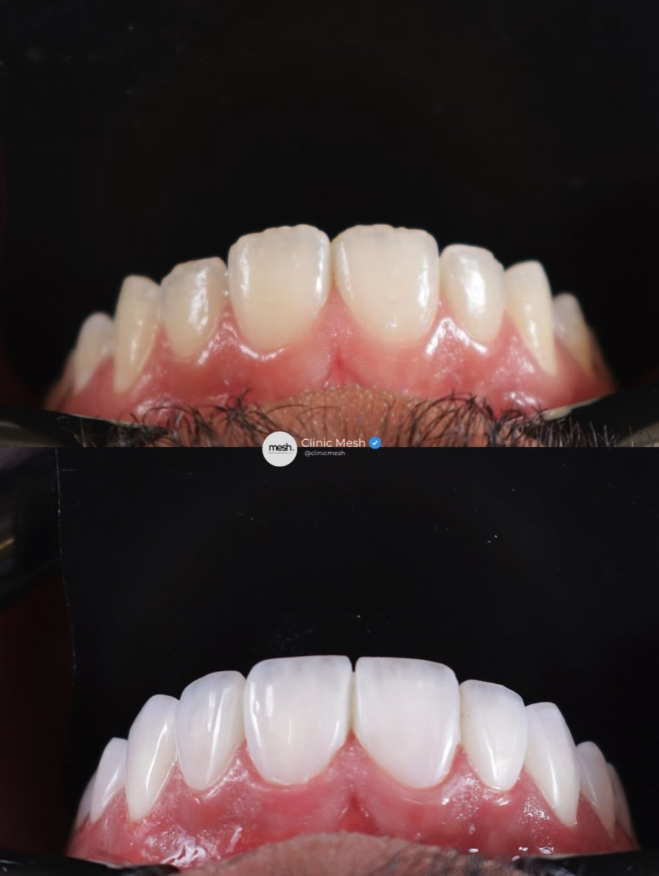 Resultado de Facetas de Resina Composta — Mesh Clinic